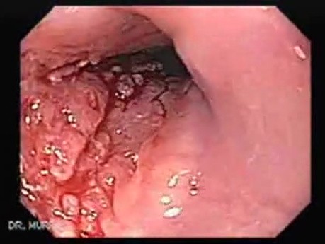 Esophageal Squamous Cell Carcinoma (2 of 2 )
