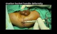 Low Anorectal Malformations