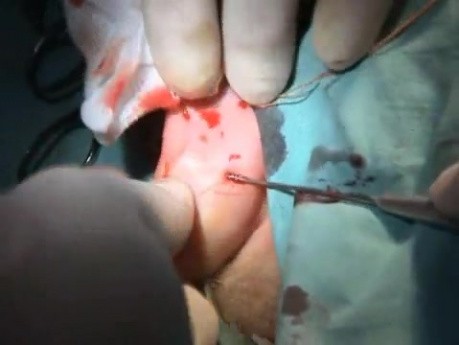 Otoplasty auriculoplasty in prominent ears - Scarless Method