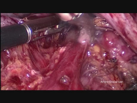 Ovarian Cancer Cytoreductive Surgery. The Laparoscopic Pelvic Peritoniectomy.
