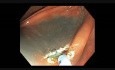 Colonoscopy Channel - How To Perform EMR - Lesion D