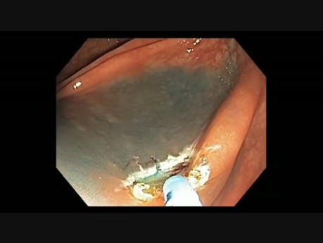 Colonoscopy Channel - How To Perform EMR - Lesion D