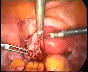 Laparoscopic Distal Tubal Repermeabilisation After Sterilisation