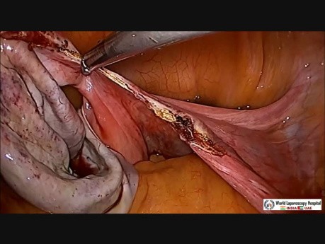 Salpingo Oophorectomy with Appendectomy and Extraction Through Colpotomy