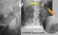 Gallbladder Opaque Stones