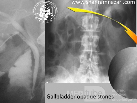 Gallbladder Opaque Stones