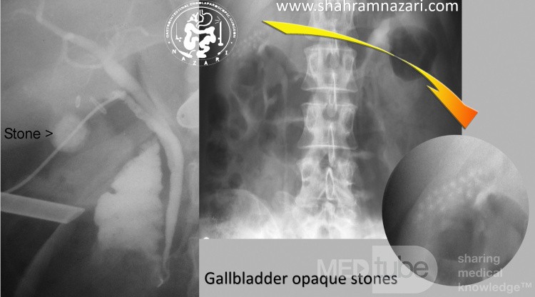 Gallbladder Opaque Stones