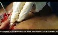 SMAS Face Lift with Lower Blephroplasty Surgery and Autologous Fat Transfer
