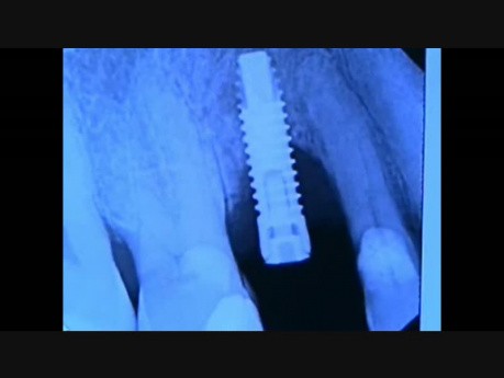 Implant Microsurgery: Failing Implant Site Repair 