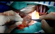 Post-Myocardial Infarction Ventricular Septal Defect Repair