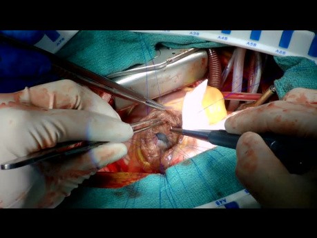 Post-Myocardial Infarction Ventricular Septal Defect Repair