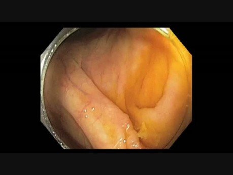 Cecum - Subtle Lesion