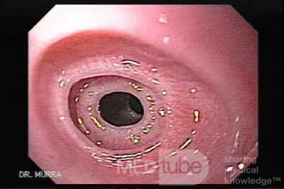 Congenital Esophageal Rings - 17 Years-Old Female