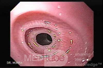 Congenital Esophageal Rings - 17 Years-Old Female