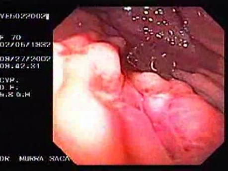 Dieulafoy´s Lesion (Exulceratio Simplex) (11 of 11)