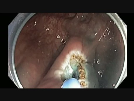 Colonoscopy - Ascending Colon Prior Failed SSA Resection