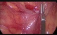 Laparoscopic Fast Right Hemicolectomy