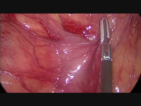 Laparoscopic Fast Right Hemicolectomy
