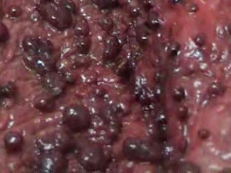 Multiple Rectal Ulcers (68 of 110)