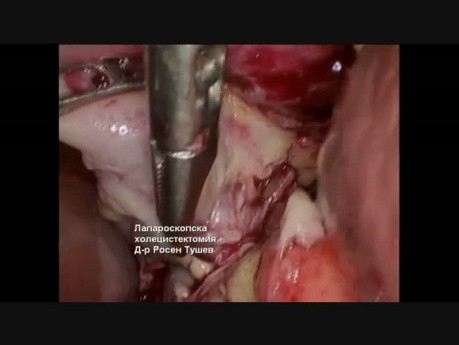 Laparoscopic Cholecystectomy - Gangrene and Empyema of the Gall Bladder