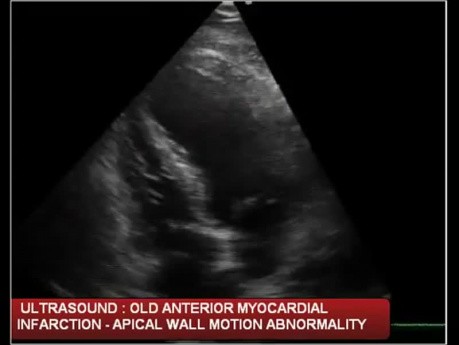 Old Anterior Wall Myocardial Infarction -apical Wall Motion Abnormality of the Left Ventricle (Echo)