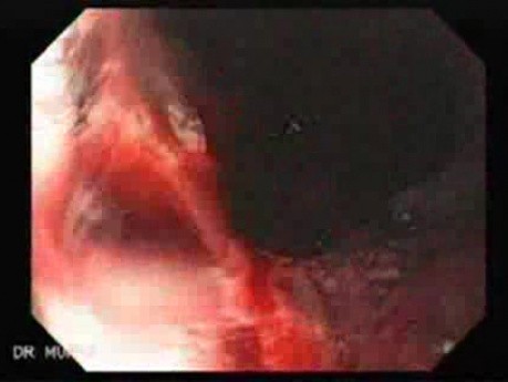 Severe Bleeding of the Upper Digestive System After Two Days of Band Ligation - Suctioning and Washing