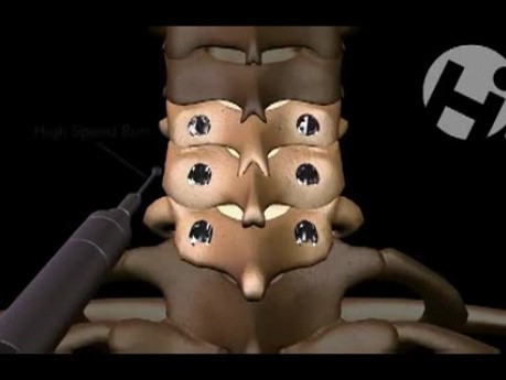 C5-C7 Posterior Fusion