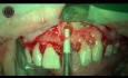 Tooth Extraction And Dental Implant Placement With Advanced Laser Technology