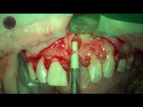Tooth Extraction And Dental Implant Placement With Advanced Laser Technology
