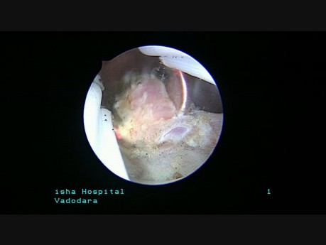 Endometrial Polyp Posterior Wall