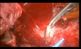 Cardiac Auto Transplantation for Recurrent Sarcoma