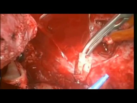 Cardiac Auto Transplantation for Recurrent Sarcoma