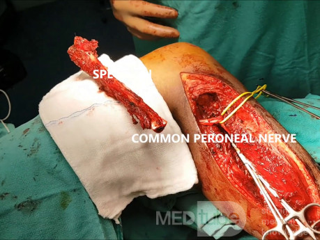 Ewing sarcoma of Head of Fibula