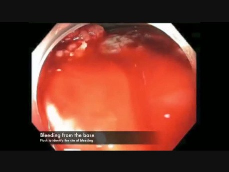 Cecum-EMR Bleed-Position Change-C