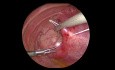 Congenital Diaphragmatic Hernia