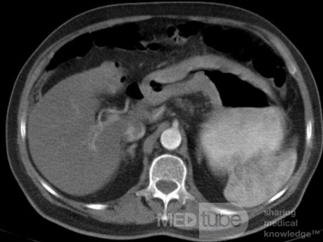 ScirrhousGastric Carcinoma (Linitis Plastica) (7 of 9)