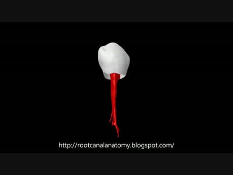 Taurodontism: Mandibular First Premolar