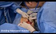 Excision of Chest Wall Chondrosarcoma Under Thoracoscopic (VATS) Guidance