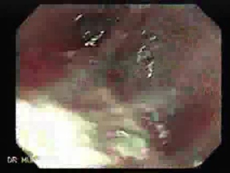 Ligation of Esophageal Varices -  Fallen Band