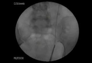 Ureteral Stones - Ureteroscopy and Laser Lithotripsy