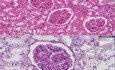 Kidney - Membranous Glomerulonephritis