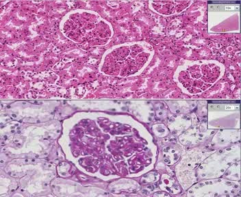 Kidney - Membranous Glomerulonephritis