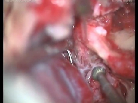 Right Facial Nerve Transposition - Posterior Rerouting