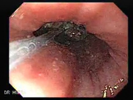 Esophageal Achalasia - Impaction of foreign bodies (piece of meat) (2 of 5)