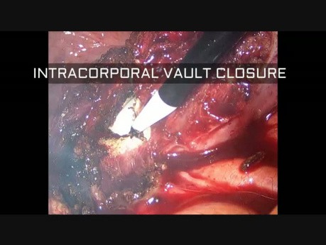 Total Laparoscopic Hysterectomy for Fibroid Uterus