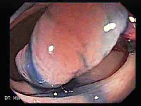 Colonoscopic Polypectomy (4 of 23)