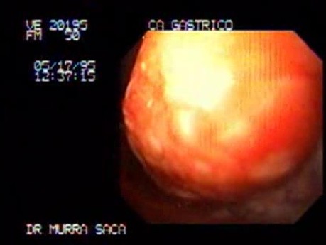 Adenocarcinoma of Stomach