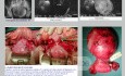 Symptomatic Cervical Myoma Abdominal Hysterectomy