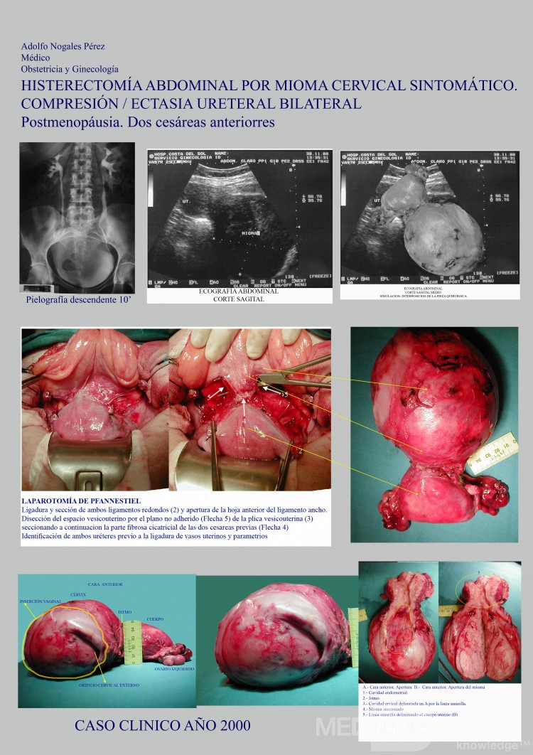 Symptomatic Cervical Myoma Abdominal Hysterectomy