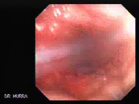 Colonoscopy with Dilation (1 of 8)